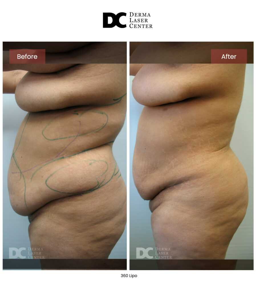 before after lipo 360 13