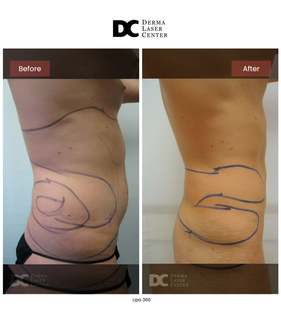 before after lipo 360 15