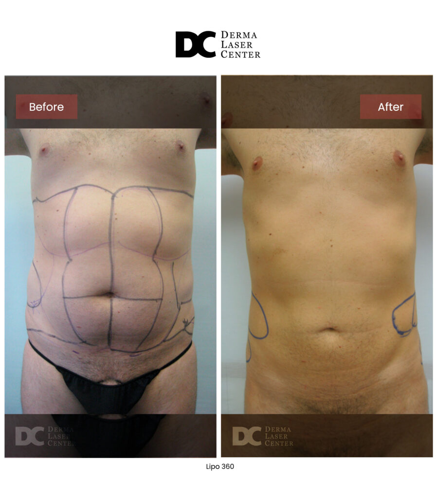 before after lipo 360 16