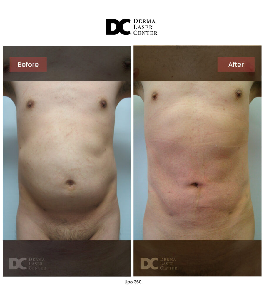 before after lipo 360 17
