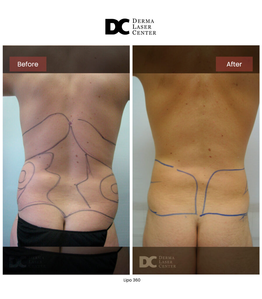 before after lipo 360 18