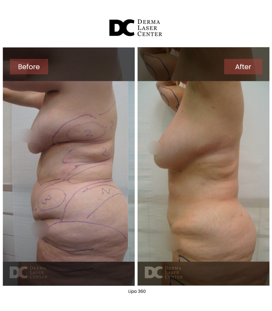before after lipo 360 20