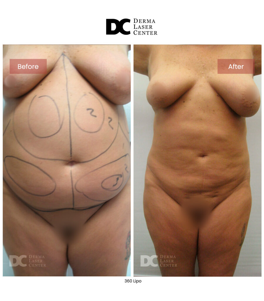 before after lipo 360 4