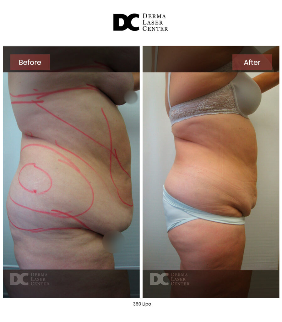 before after lipo 360 5
