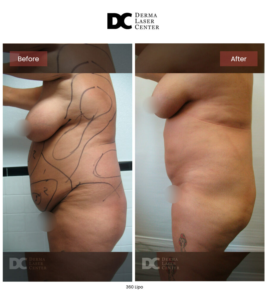 before after lipo 360 6