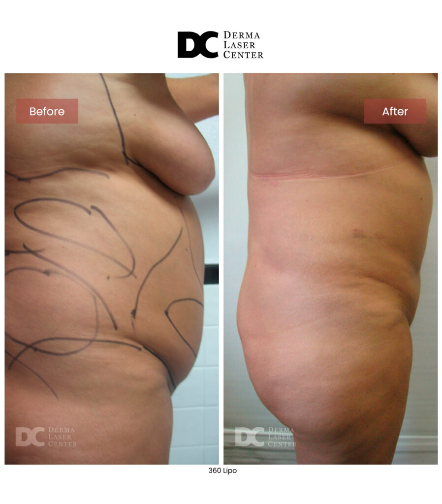 before after lipo 360 7