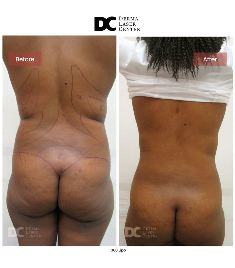 before after lipo 360 9