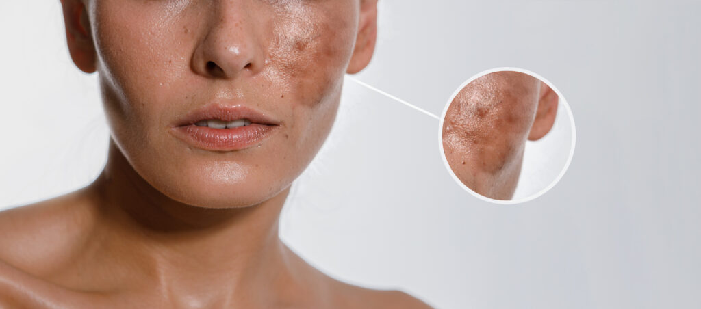 Hyperpigmentation of female skin, close up of a part of the face on a white background, cosmetology, dermatology, skin care