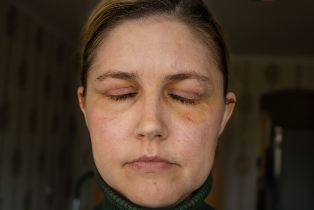 Double Eyelid Surgery, Eyes Surgery Recover Period, immediately after plastic surgery. Eyes After Eyelid Surgery