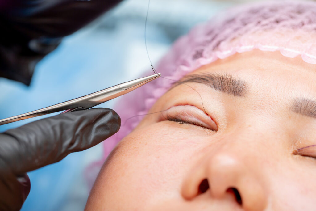 Cosmetic procedure for changing the shape of the eyes, lifting and strengthening the skin of the eyelids. Non surgical blepharoplasty with cosmetic threads. Anti aging cosmetology. Asian eye size.