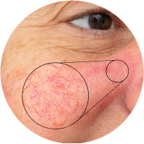 Laser Facial Veins Treatment Photos