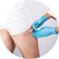 Spider Vein Treatment Pictures