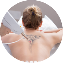 Tattoo Removal Photos