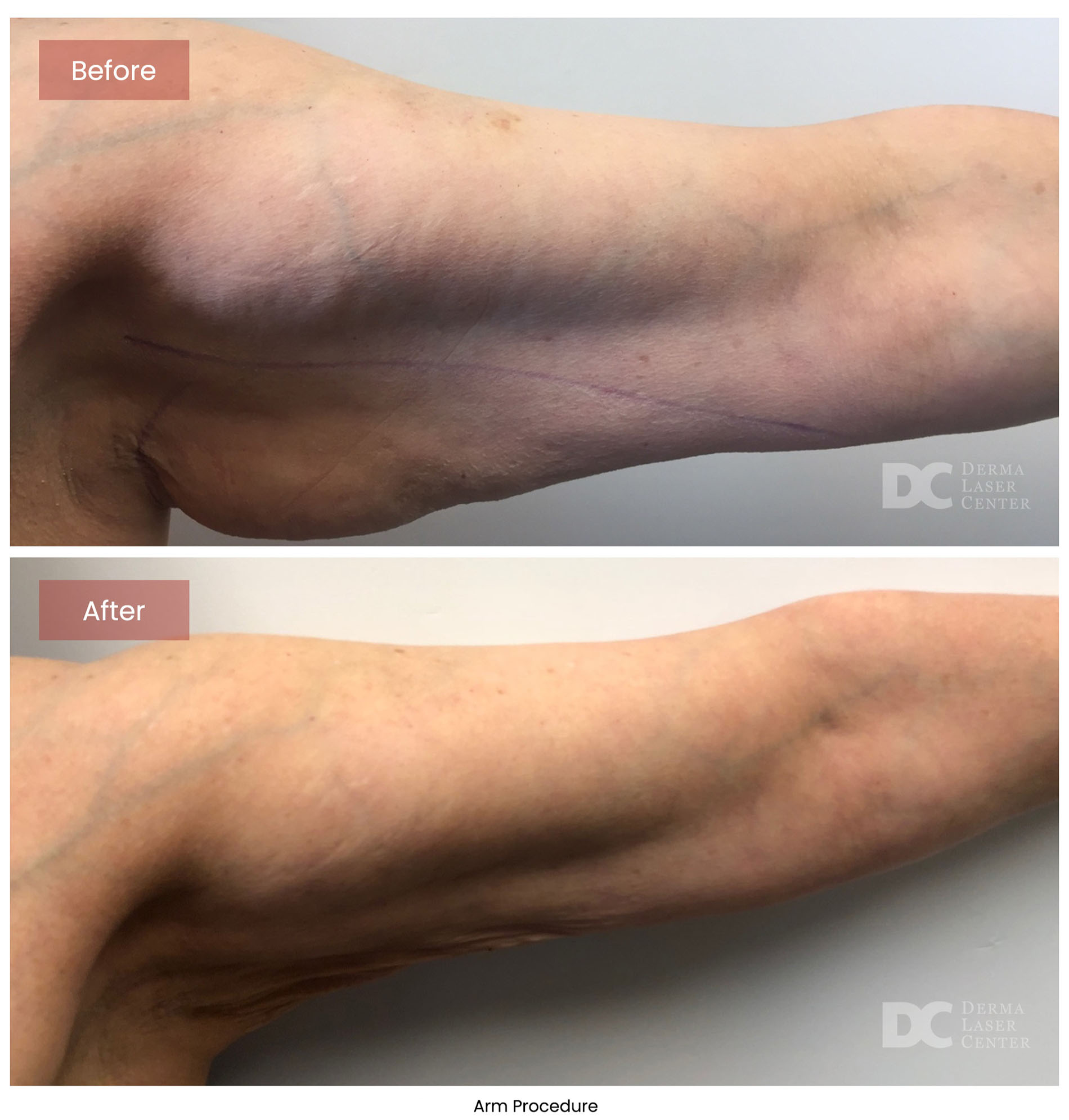 before after arrms 1