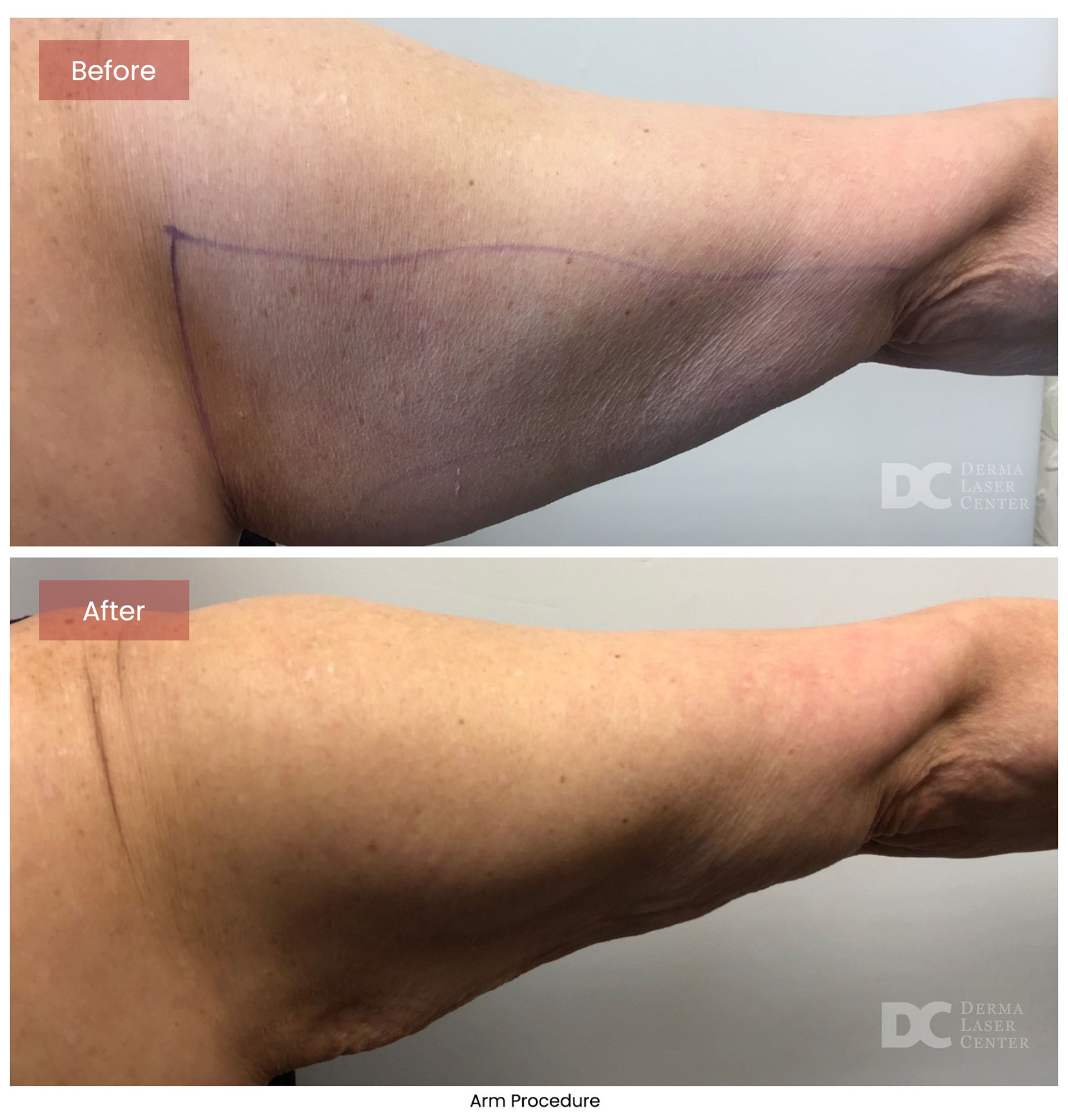 before after arrms 10