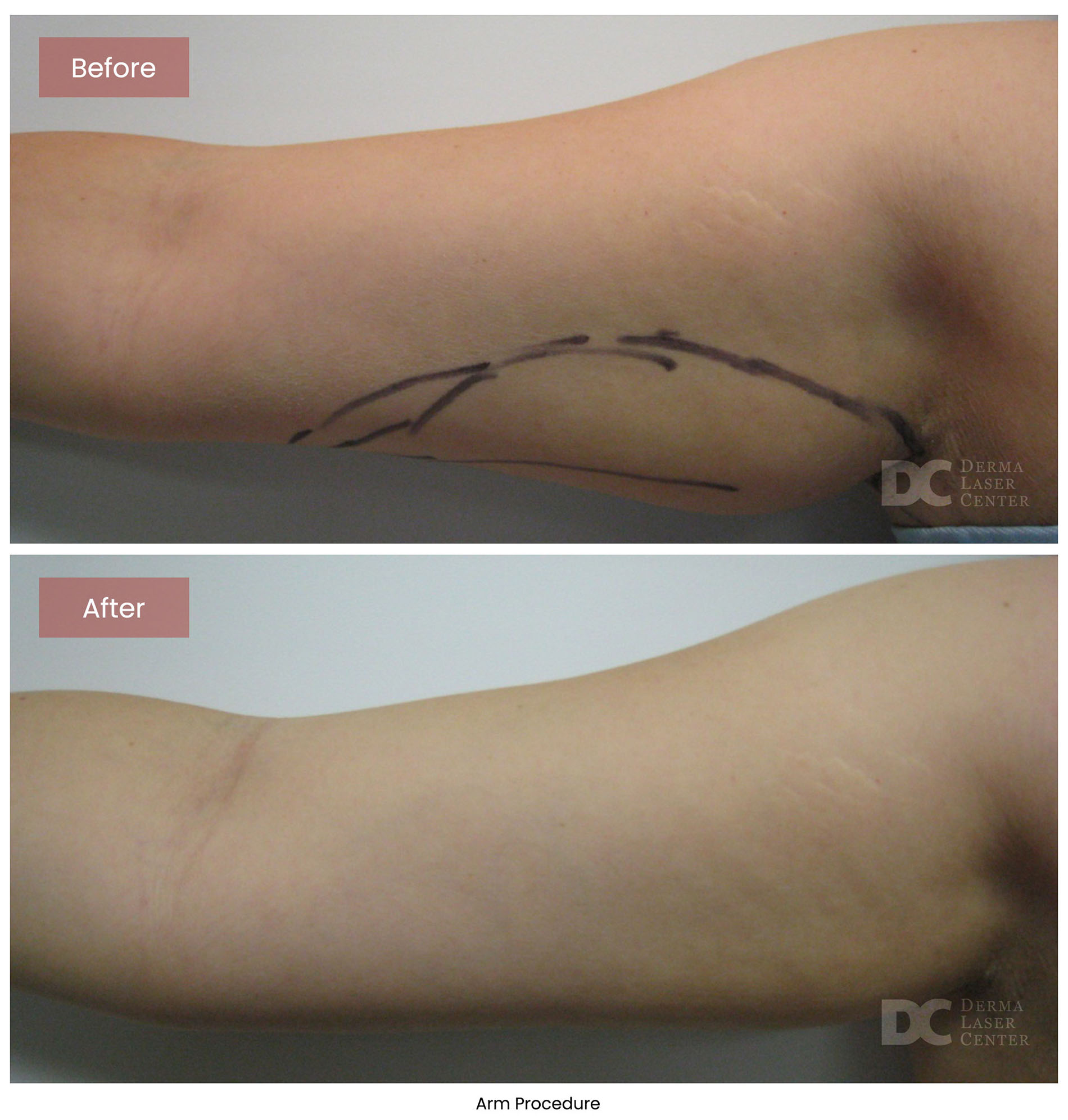 before after arrms 11