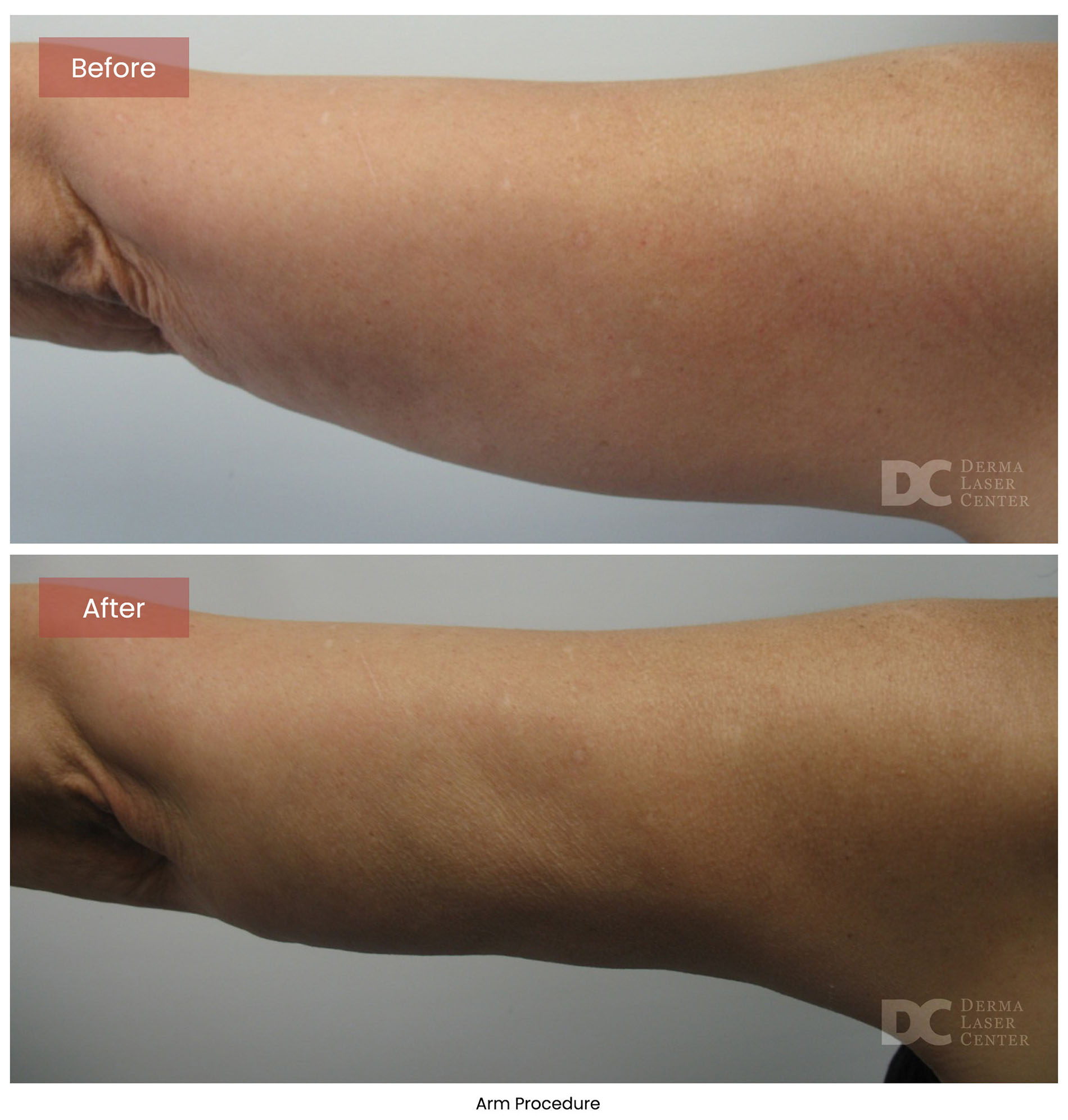 before after arrms 13