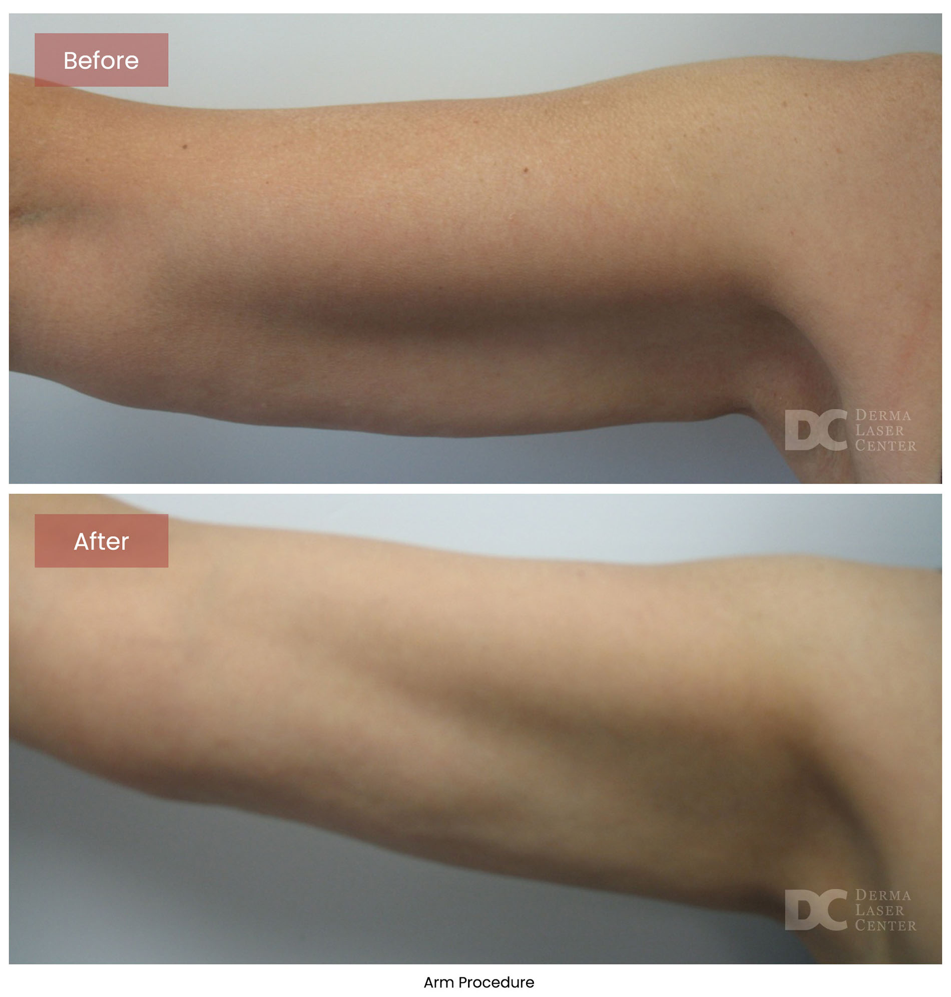 before after arrms 14