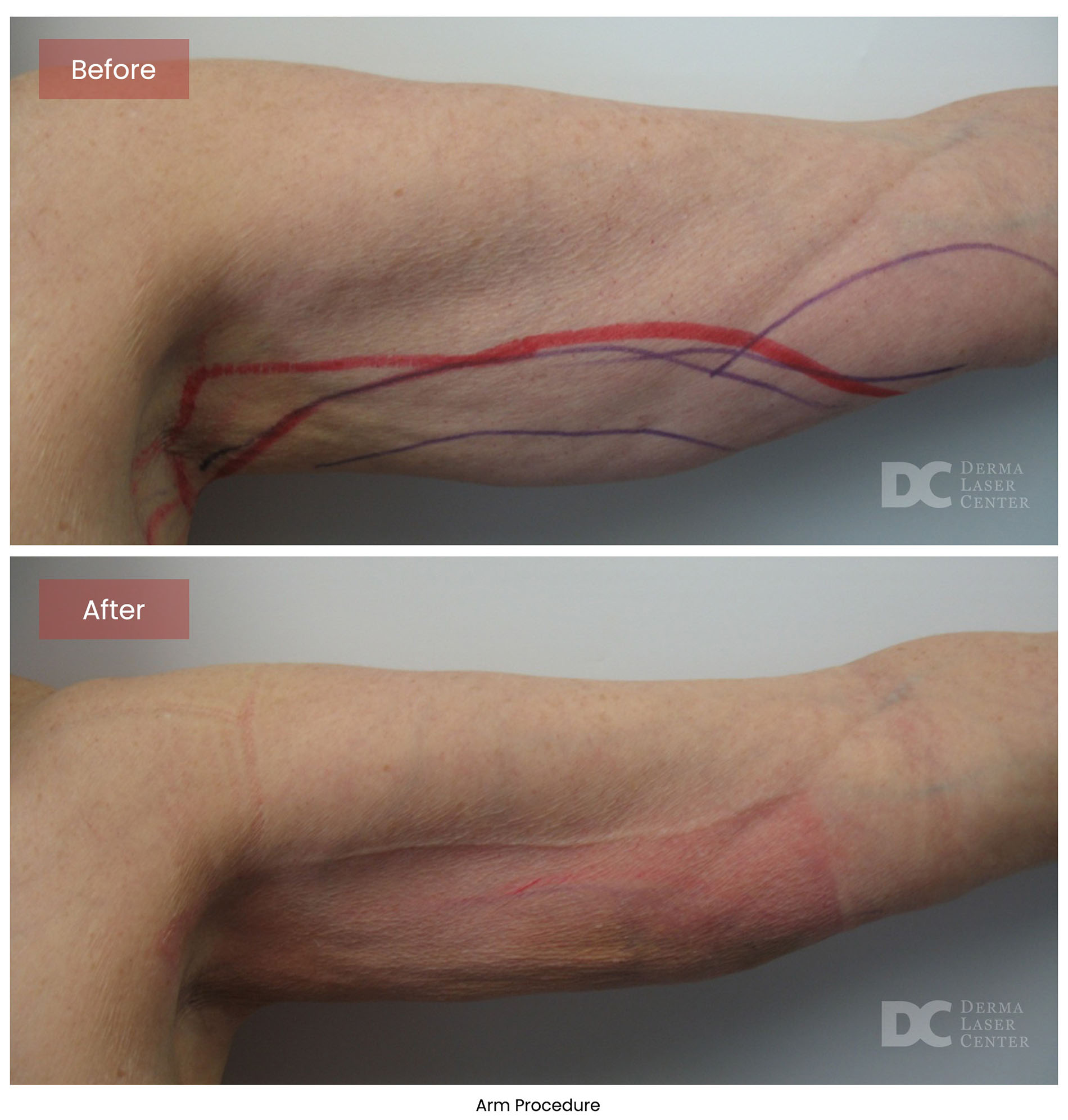 before after arrms 16