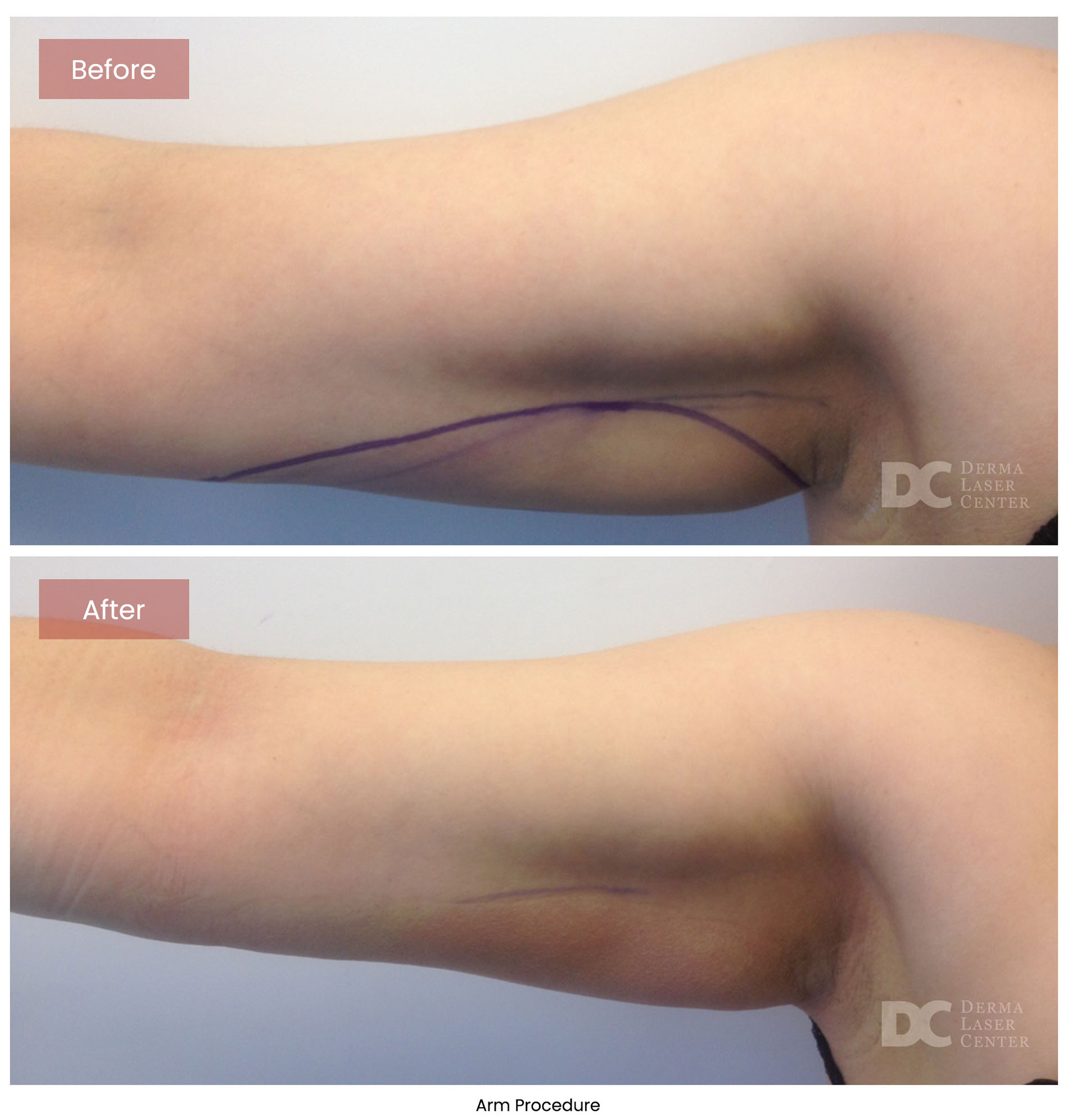 before after arrms 17