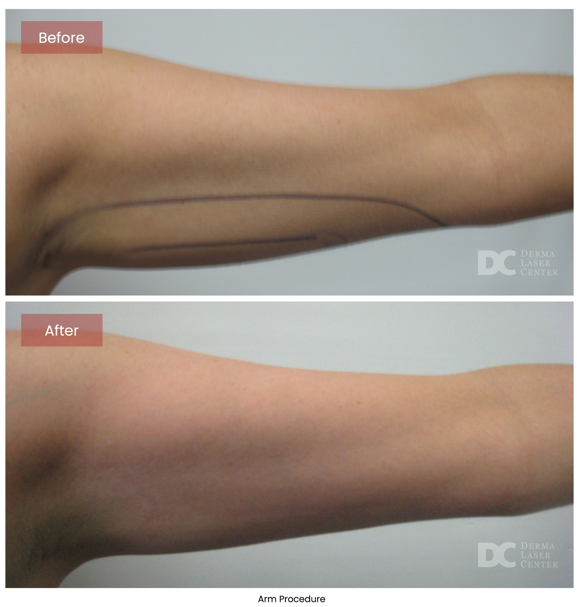 before after arrms 19