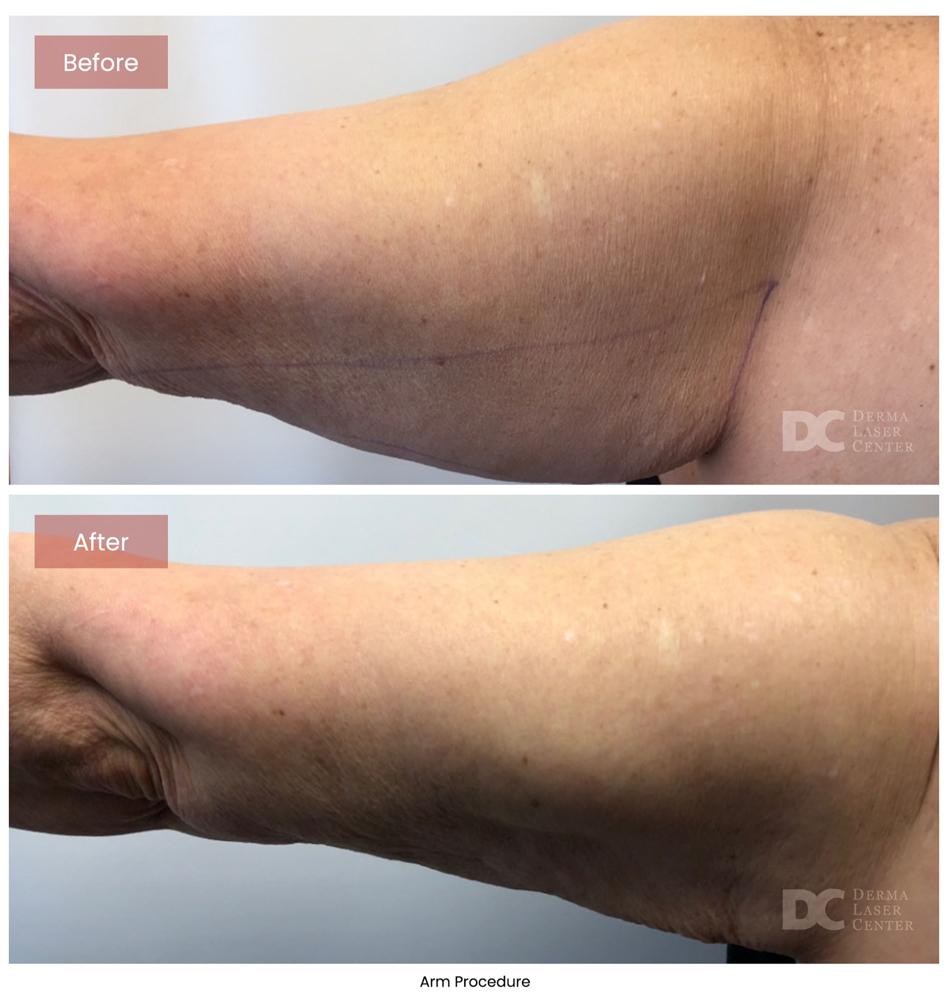 before after arrms 2