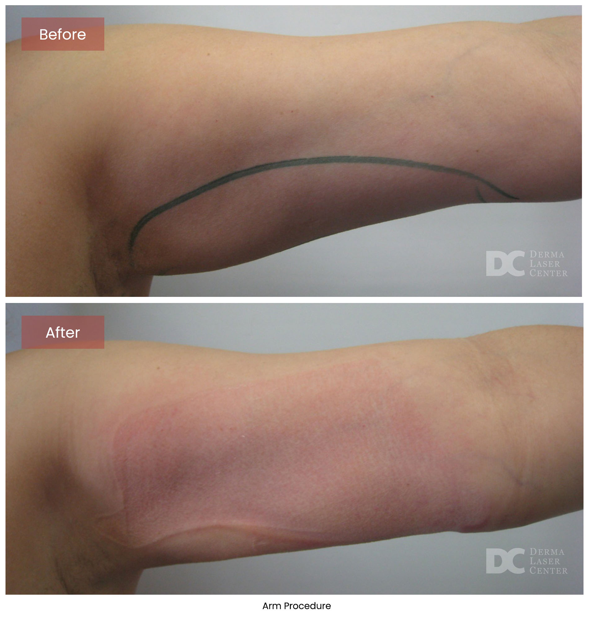 before after arrms 21