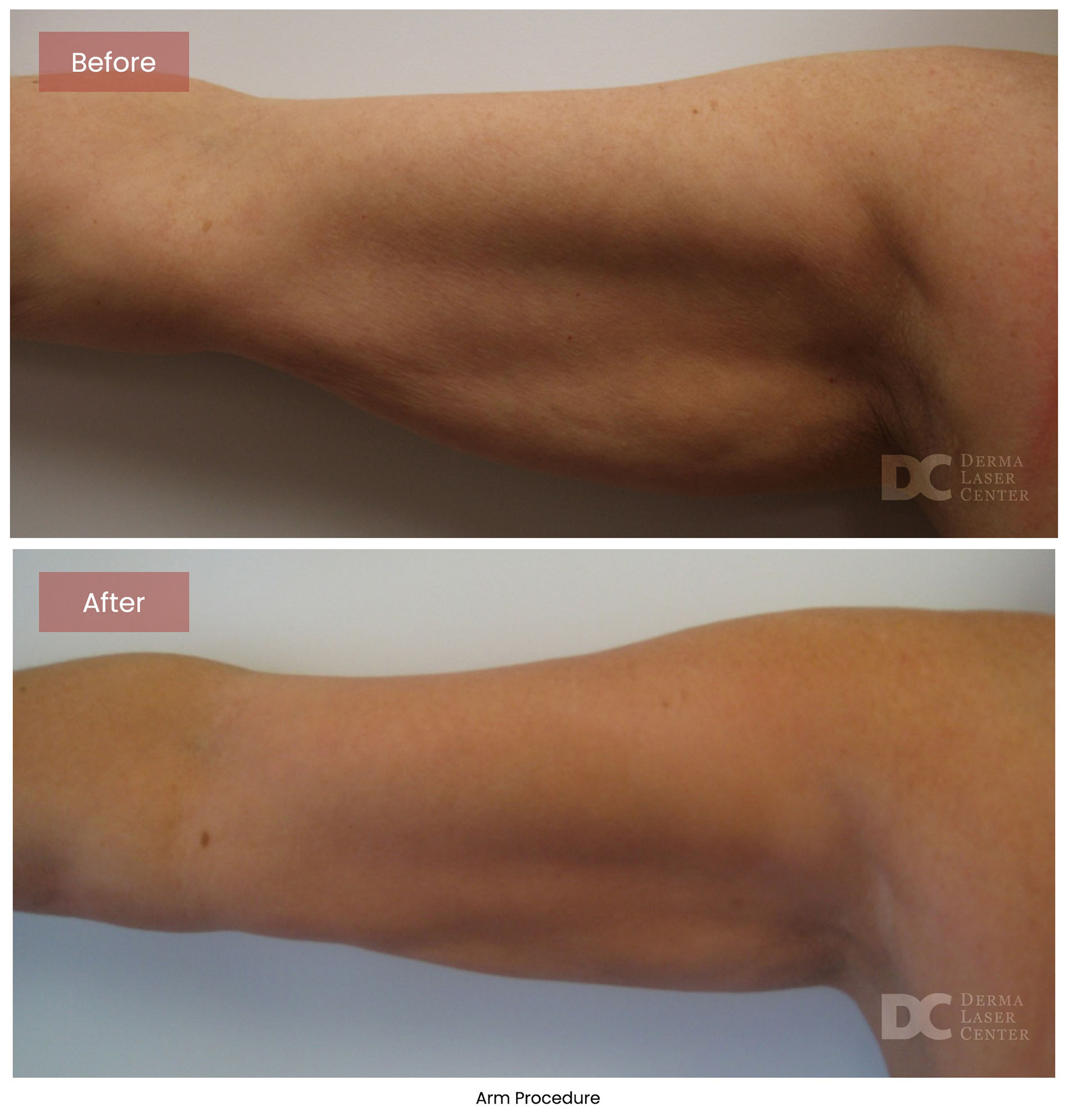 before after arrms 23