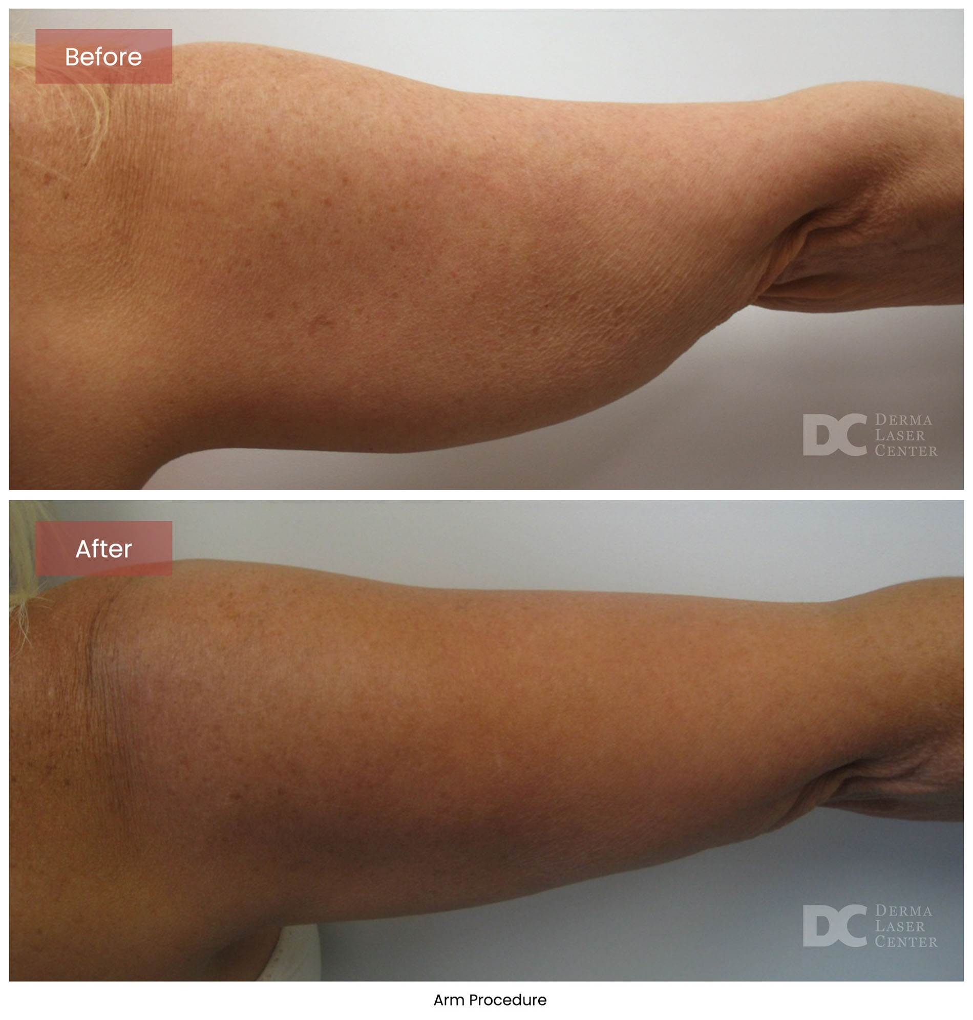 before after arrms 24