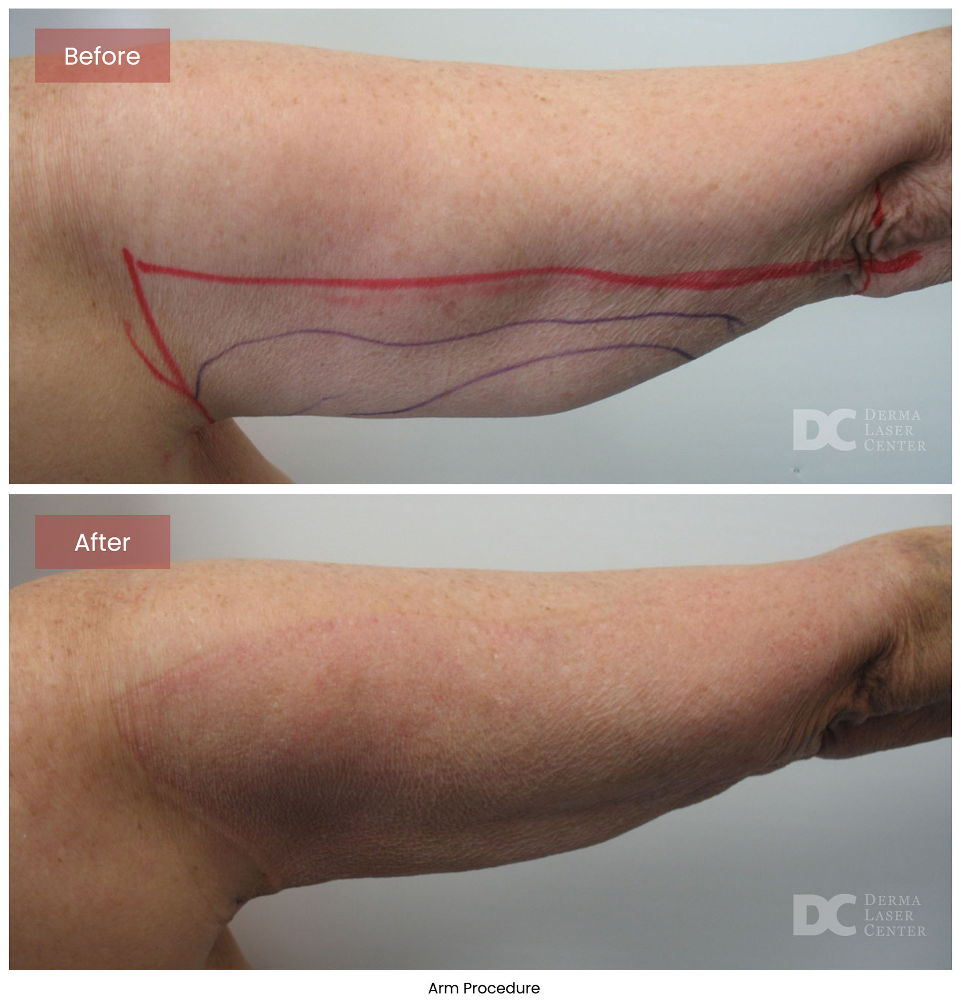 before after arrms 26