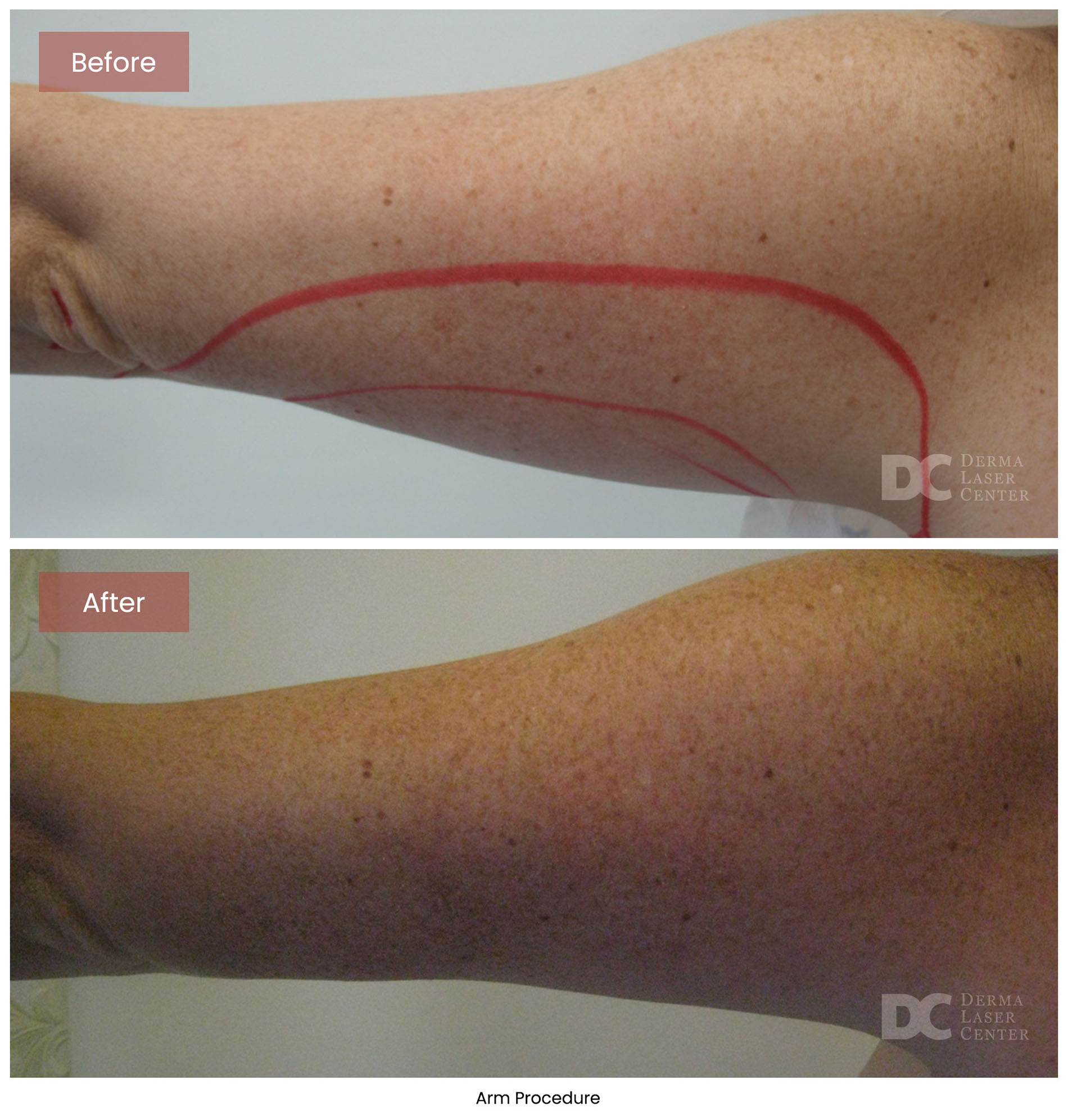 before after arrms 29