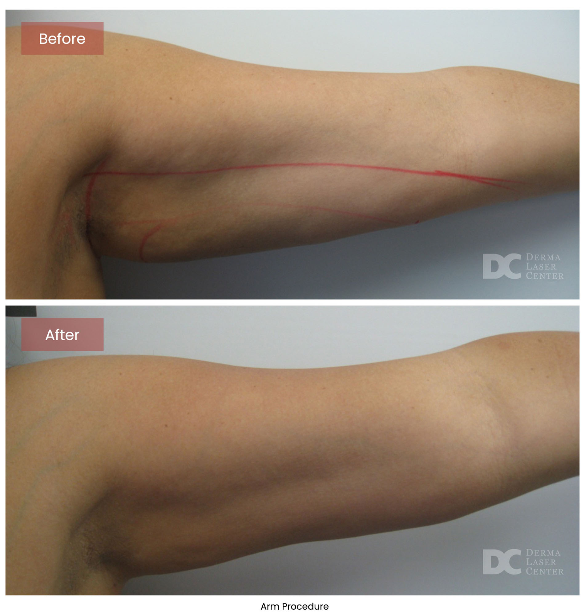 before after arrms 3