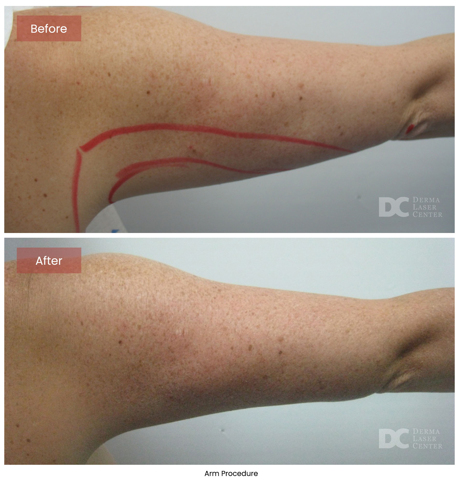 before after arrms 30