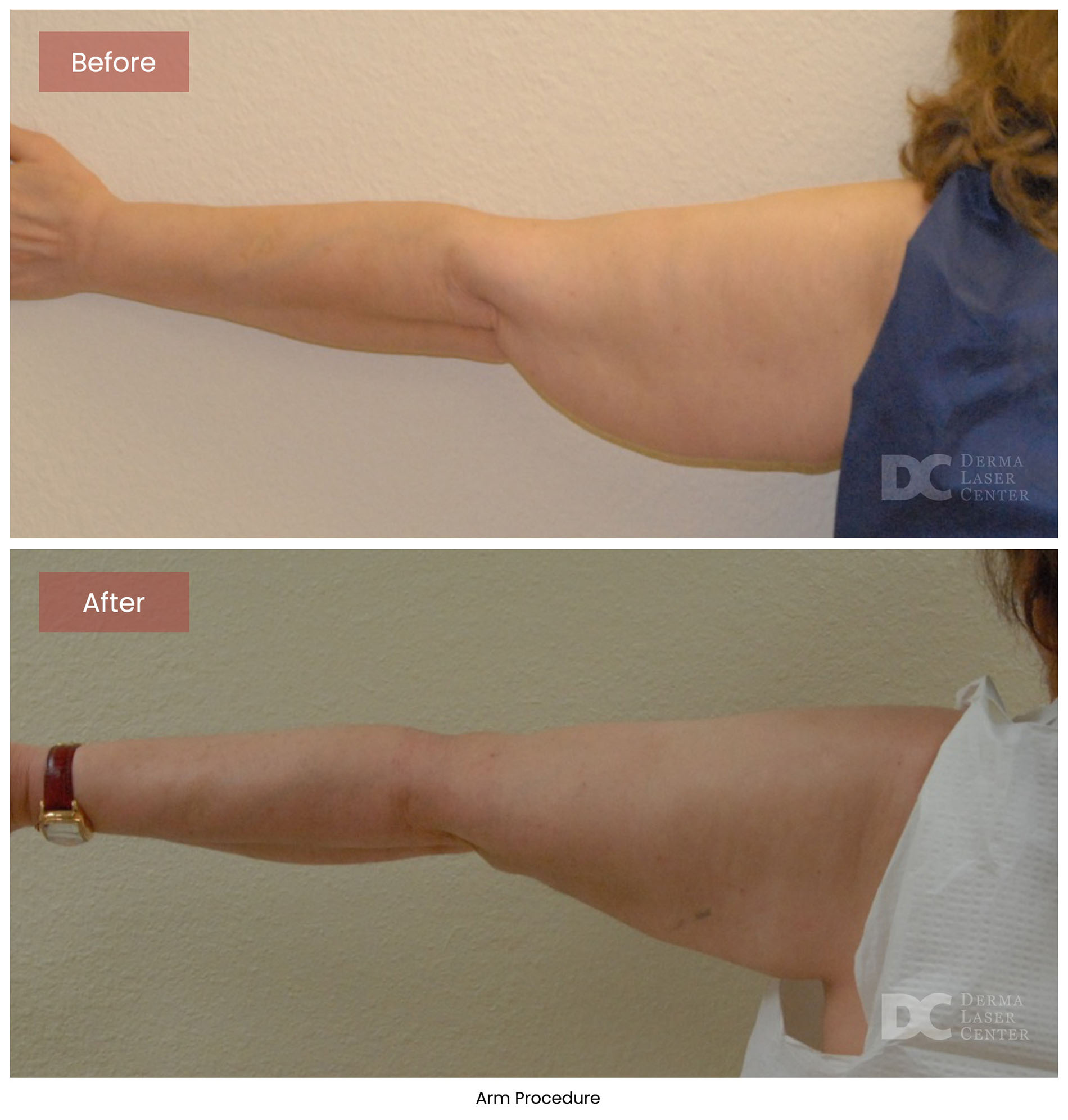 before after arrms 31