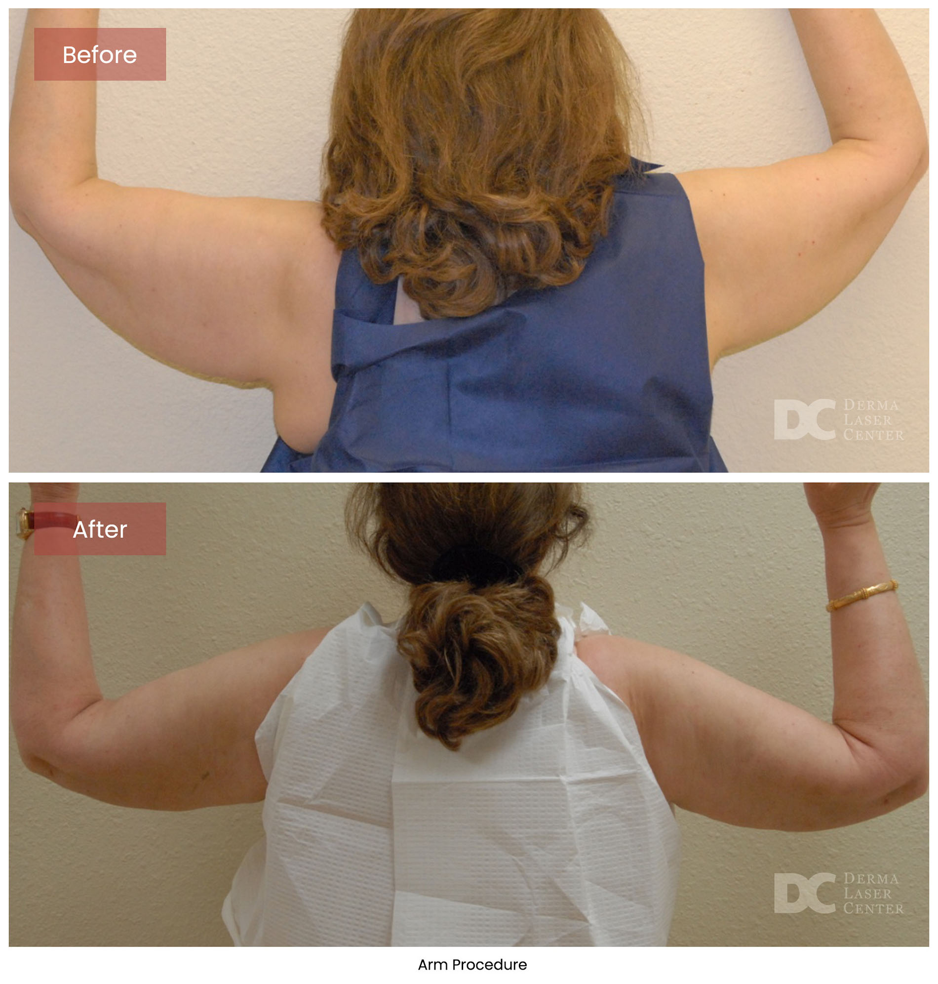 before after arrms 32