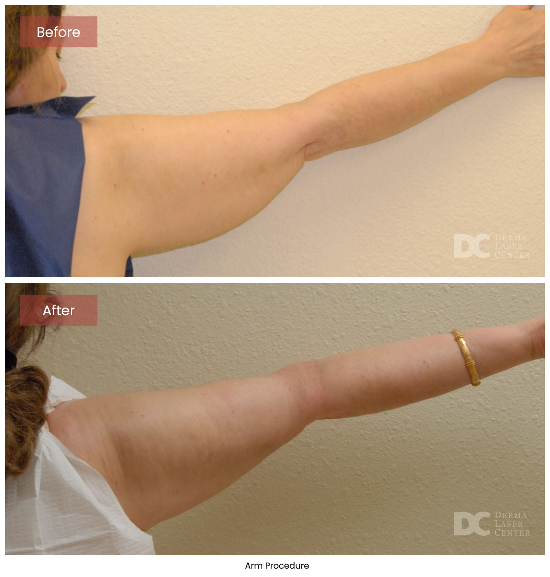 before after arrms 33