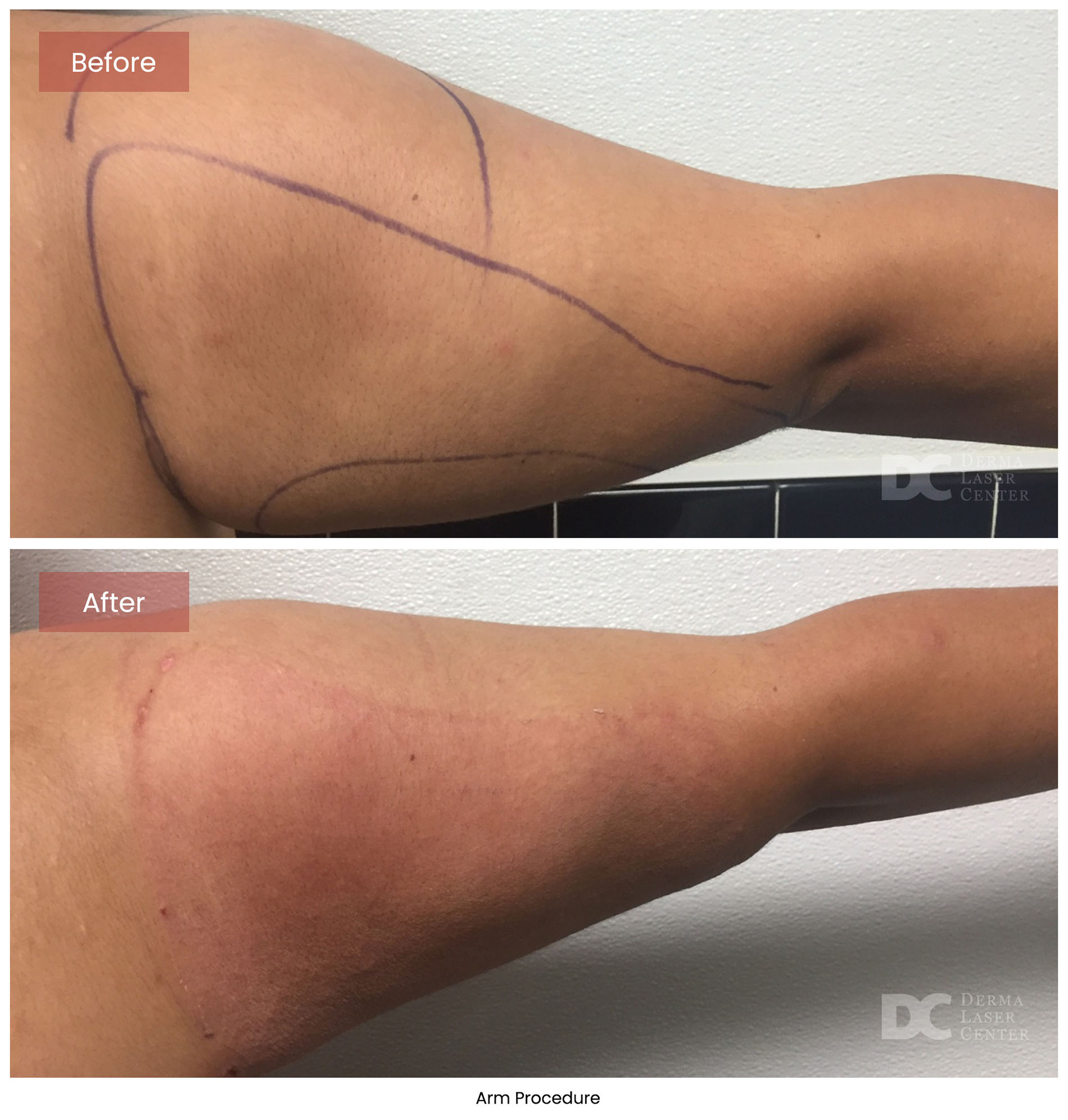 before after arrms 34