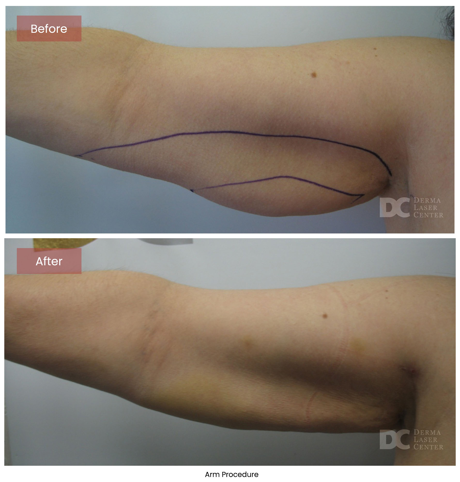 before after arrms 36