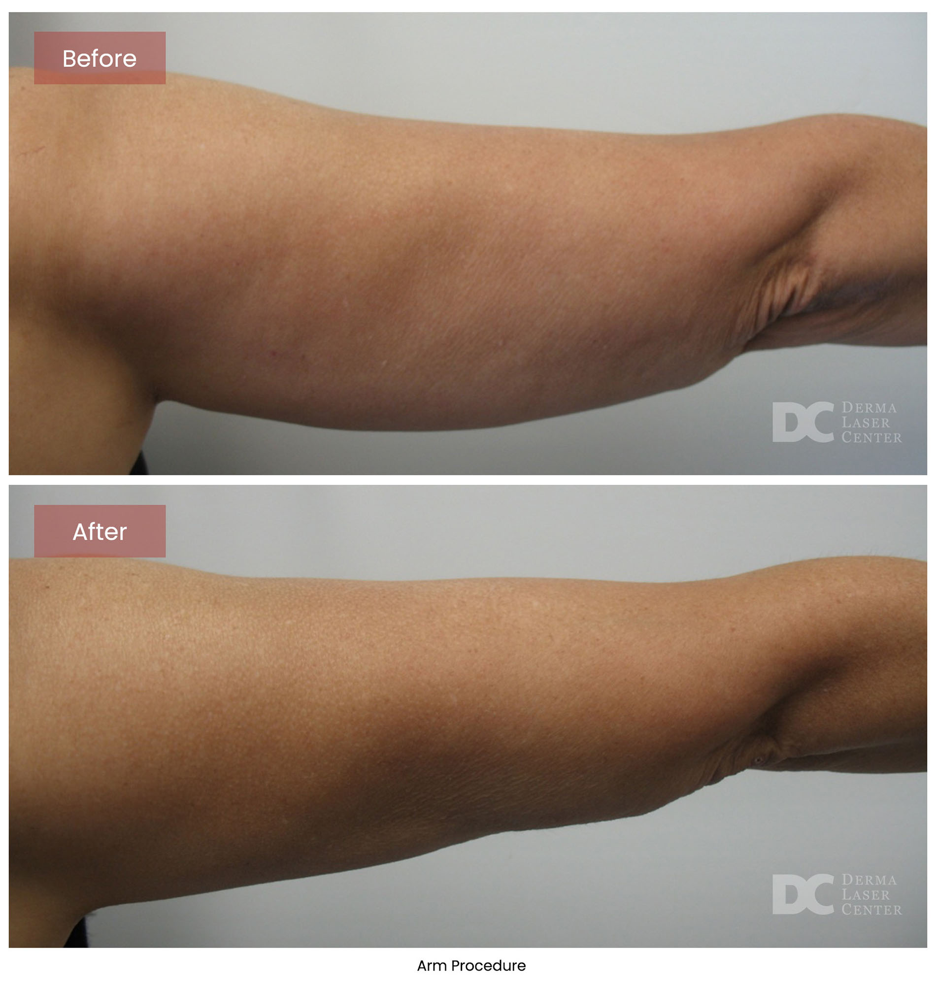 before after arrms 37