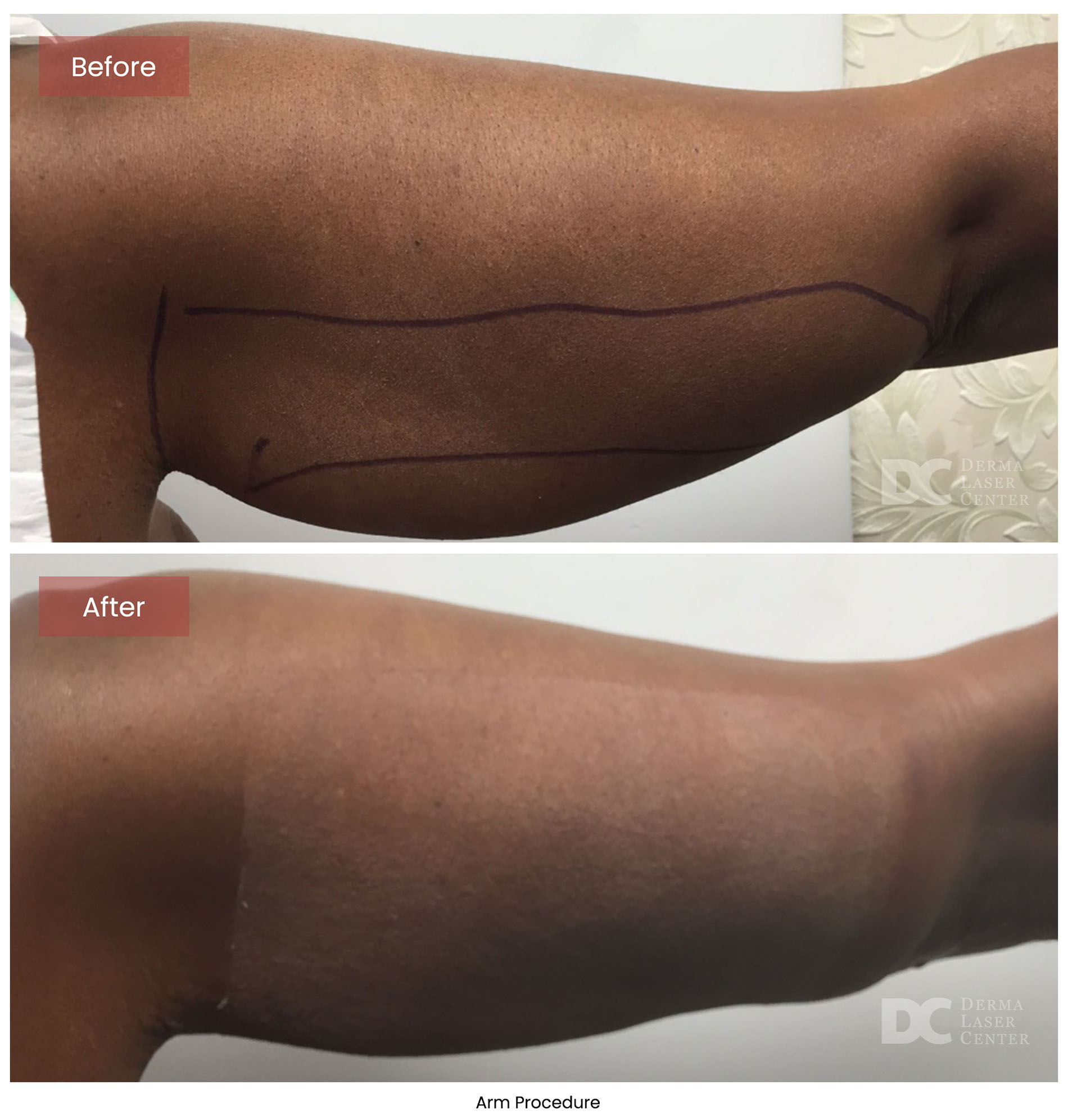 before after arrms 38