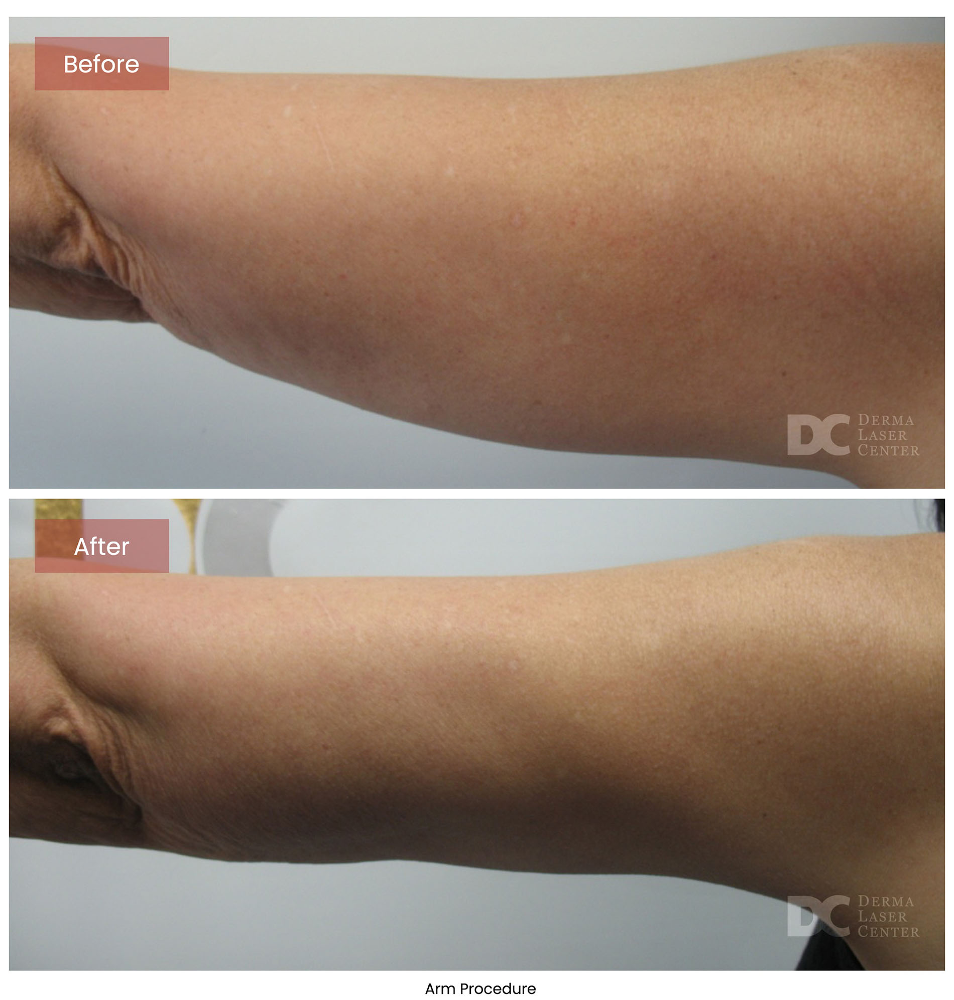 before after arrms 4