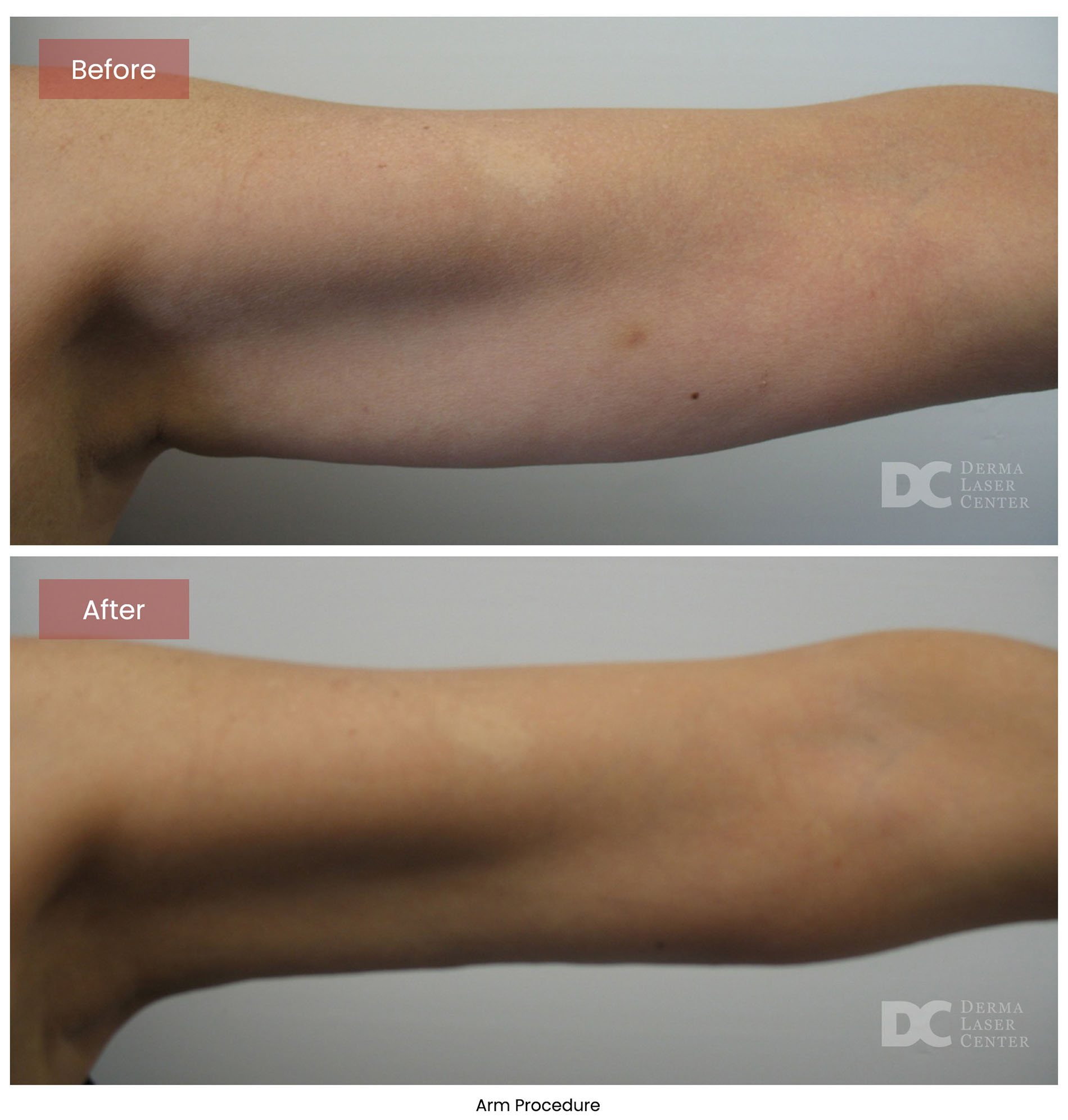 before after arrms 5