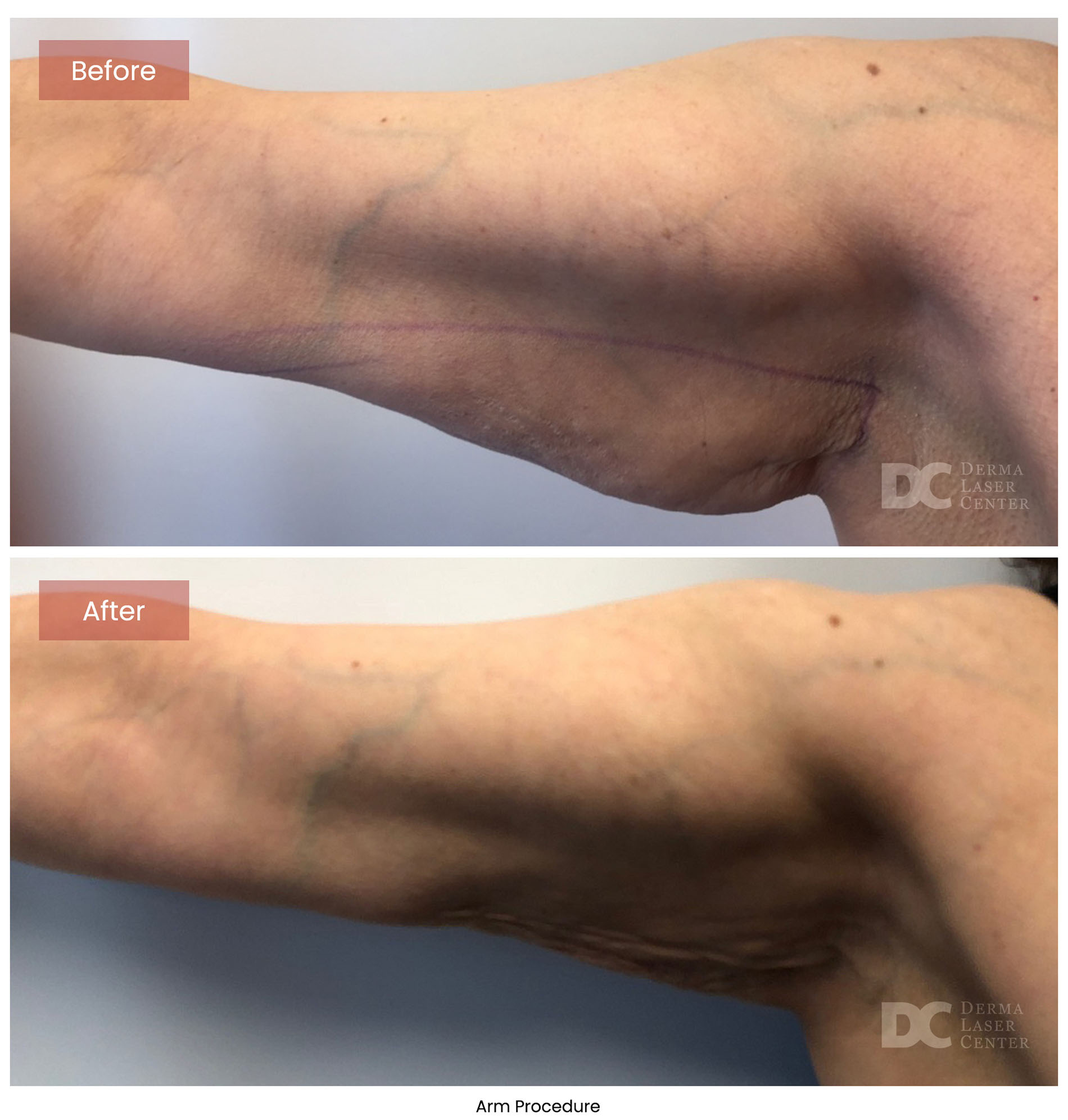 before after arrms 6