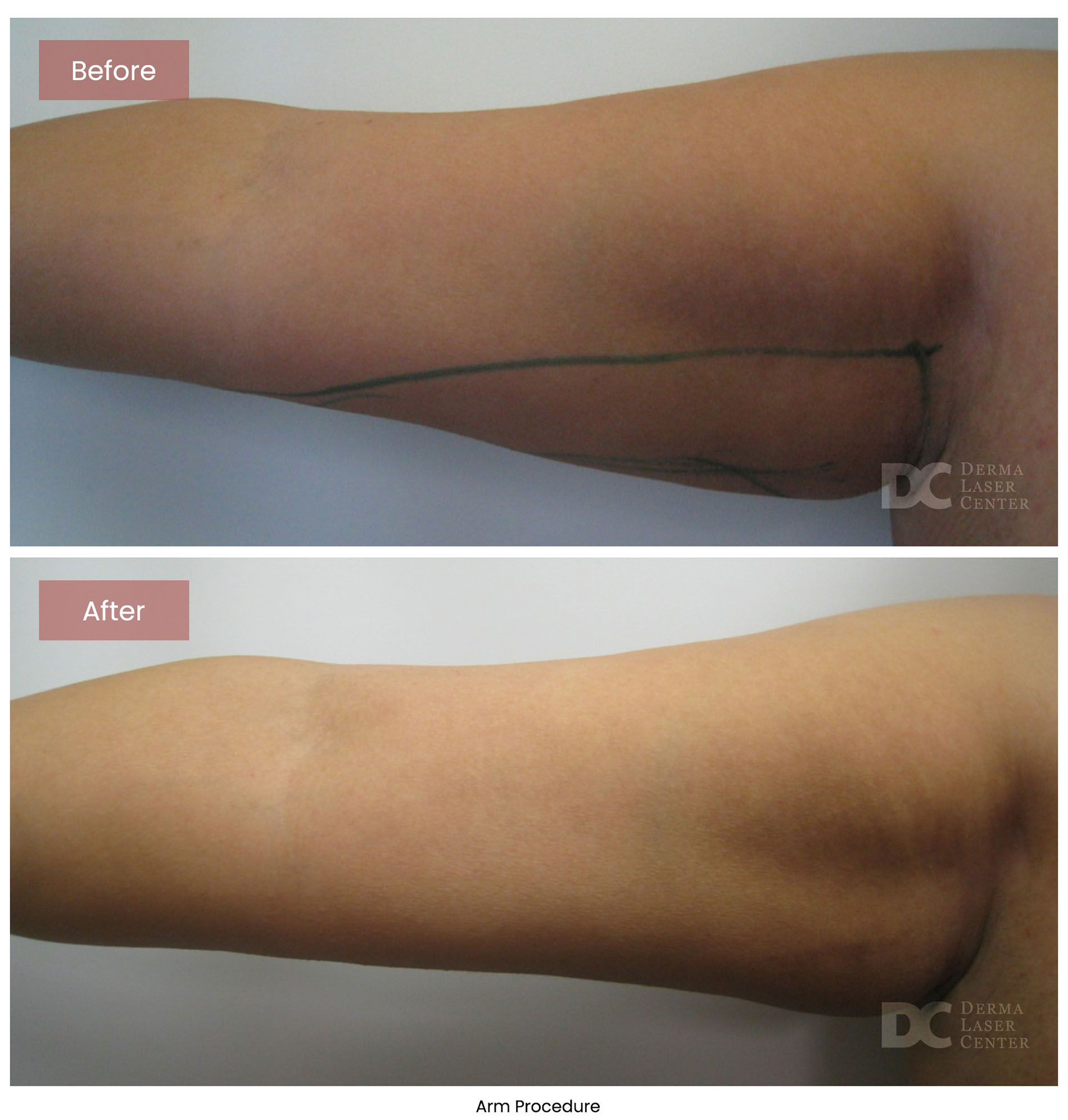 before after arrms 7