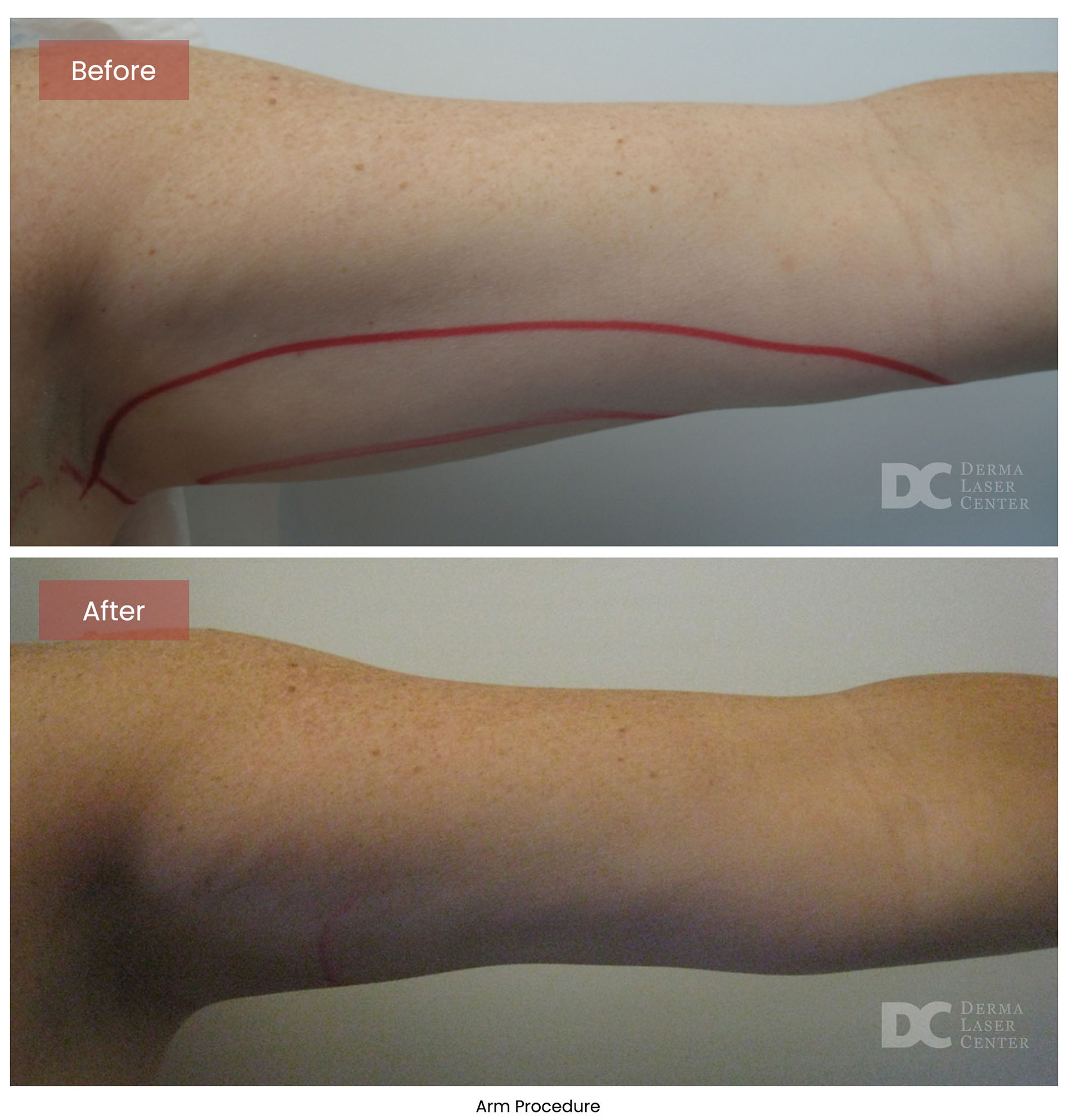 before after arrms 8