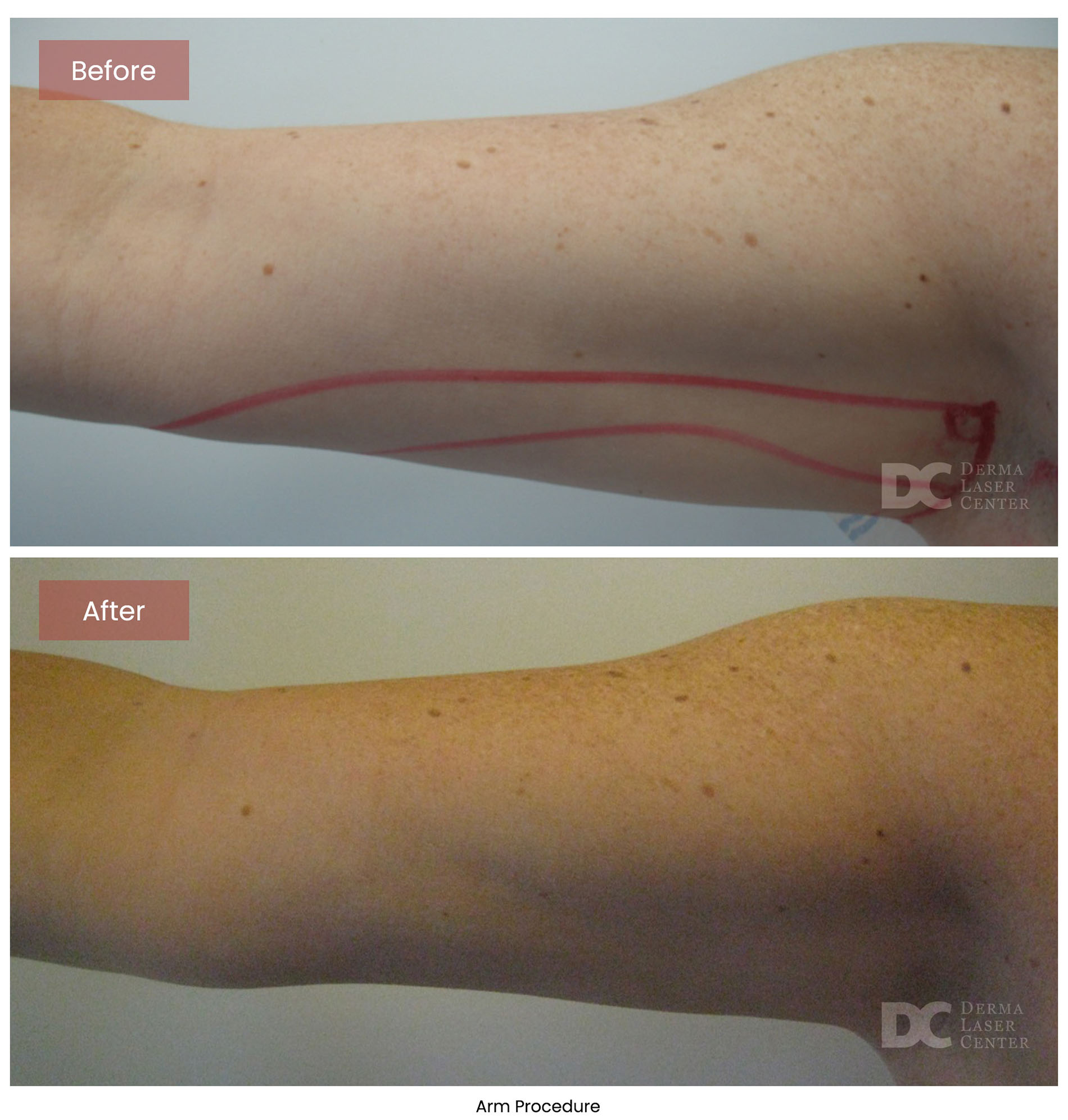 before after arrms 9