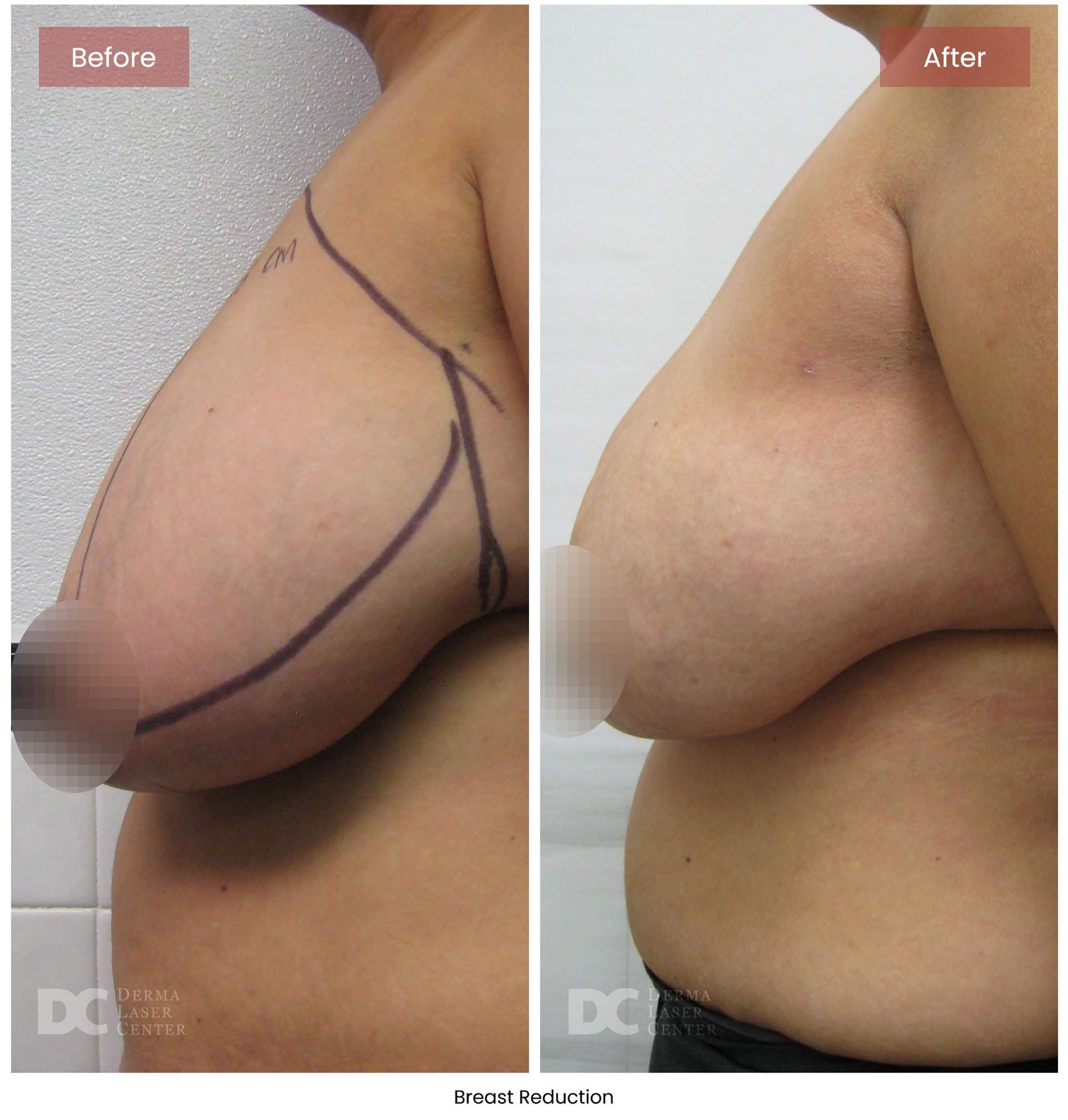 before after breast 2