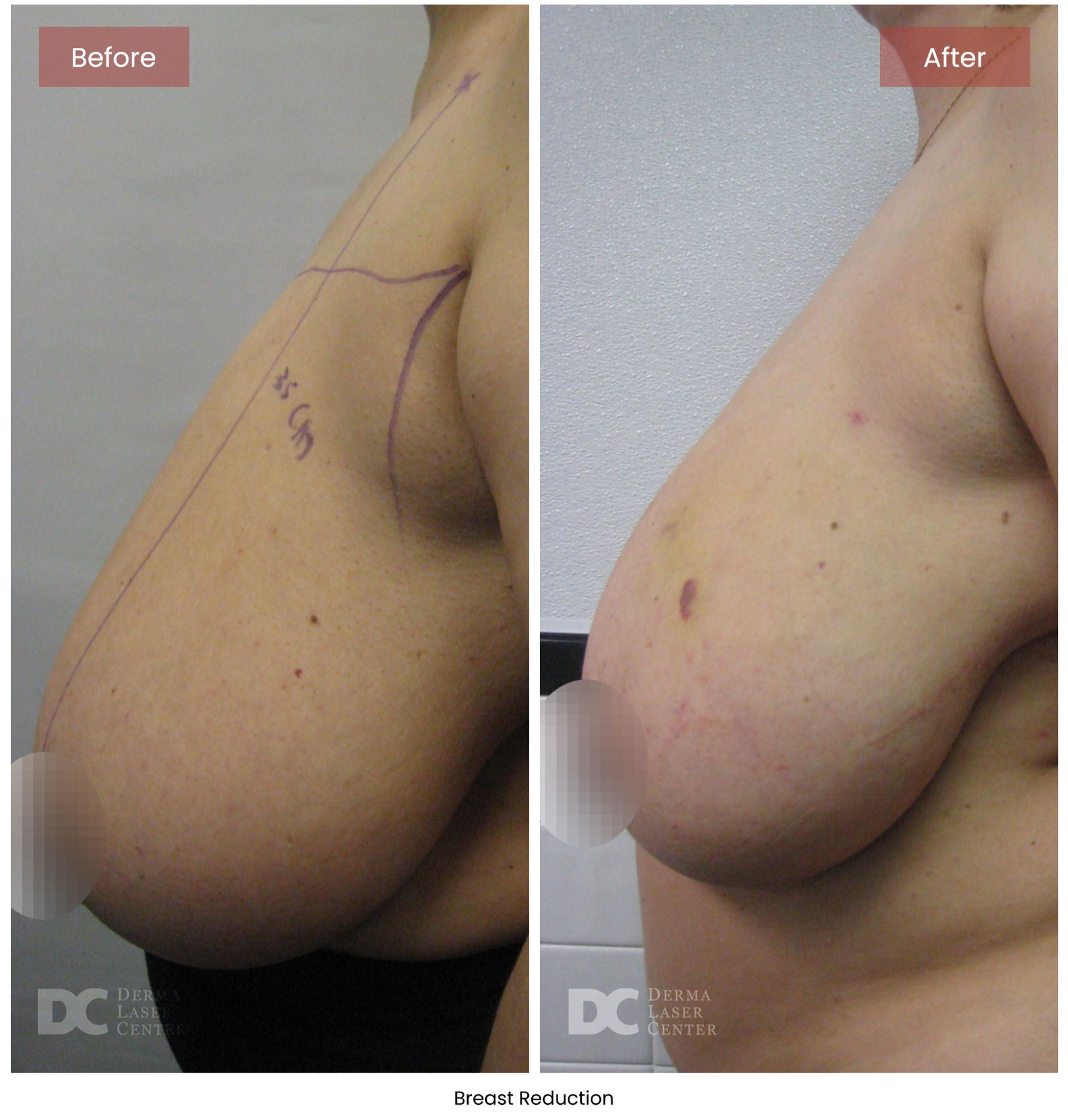 before after breast 3