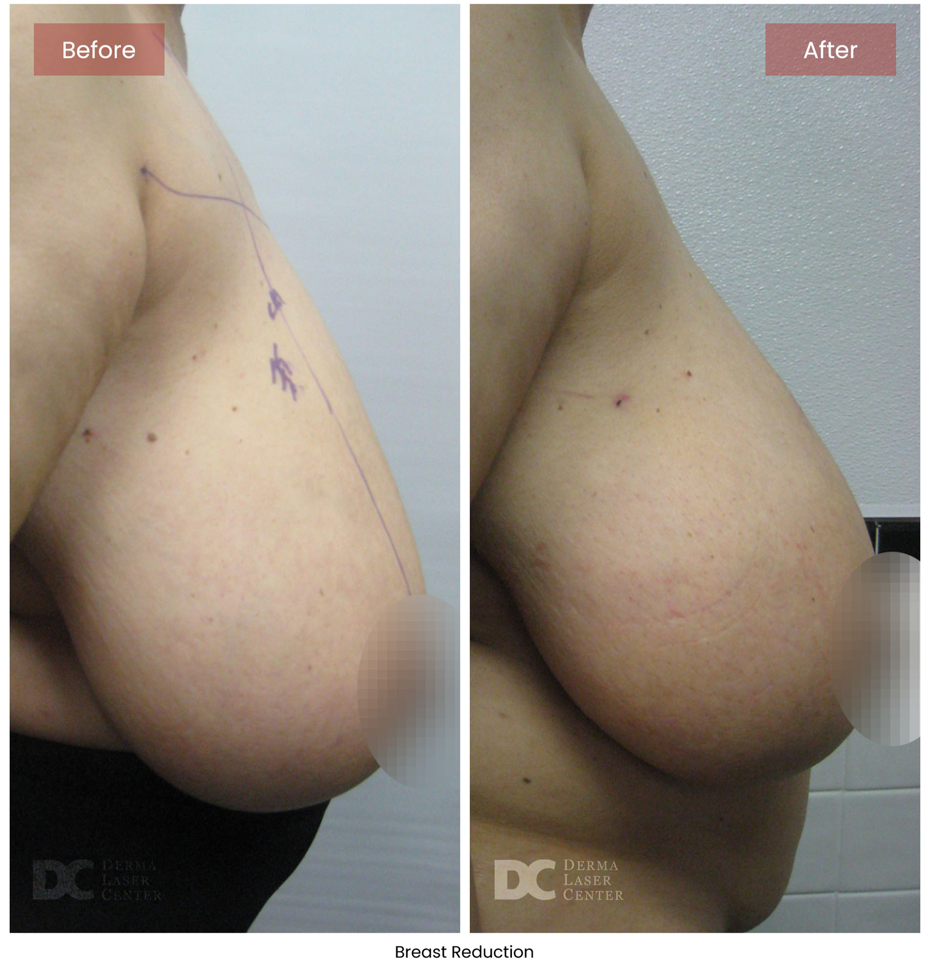 before after breast 4