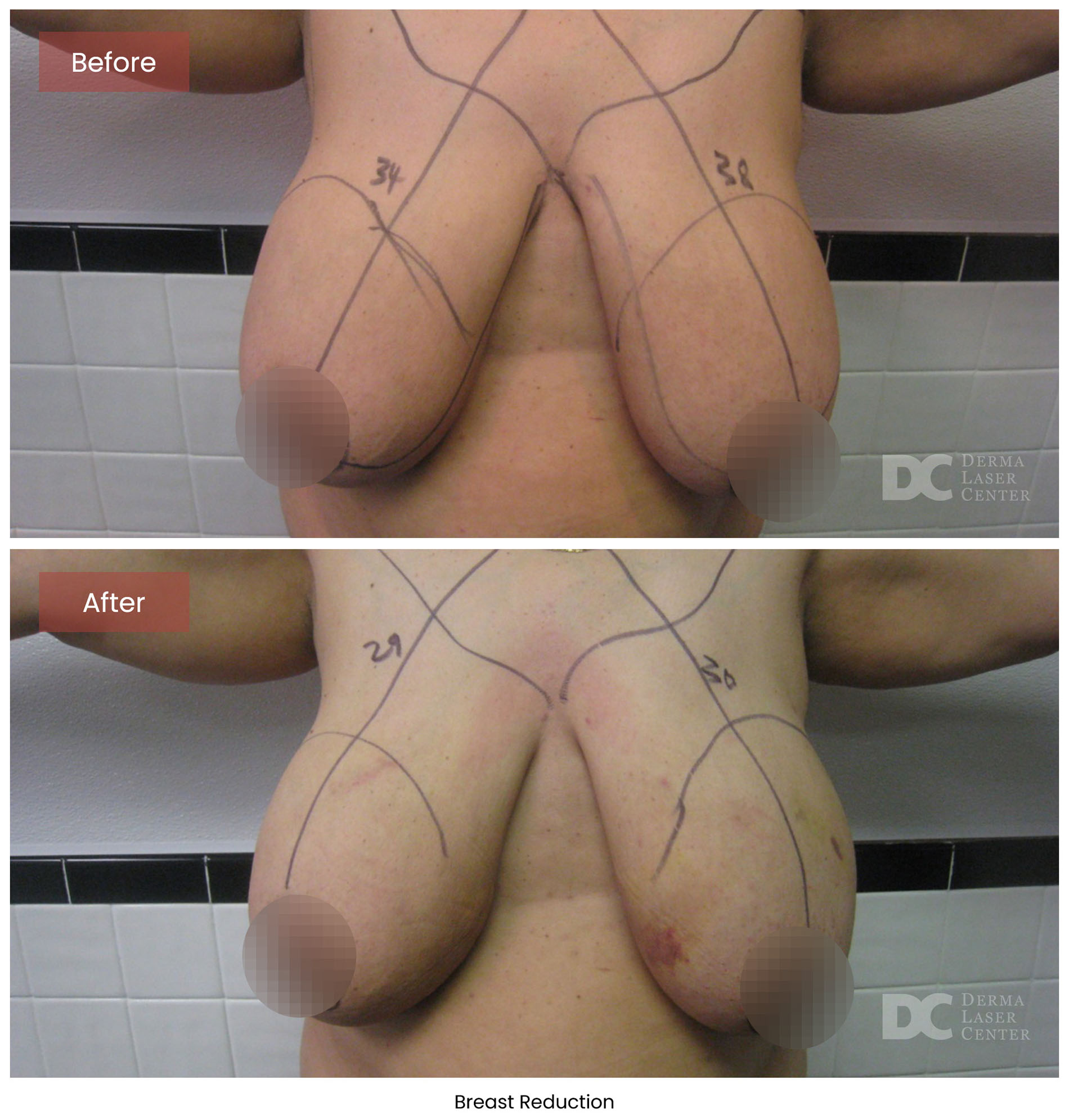 before after breast 5